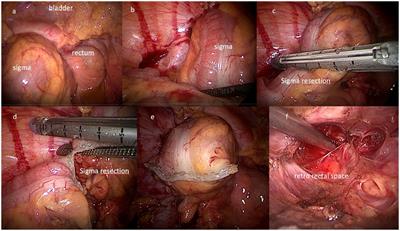 Survival as a clinical outcome and its spiritual significance in a cohort of patients with advanced central pelvic neoplastic disease undergoing total pelvic evisceration: a poorly debated issue